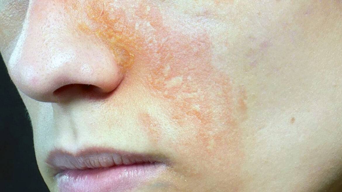 ¿Qué es la dermatitis atópica y cómo afecta a quienes viven con ella?